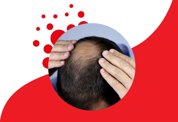 What Are The Best Supplements To Prevent Hair Loss?